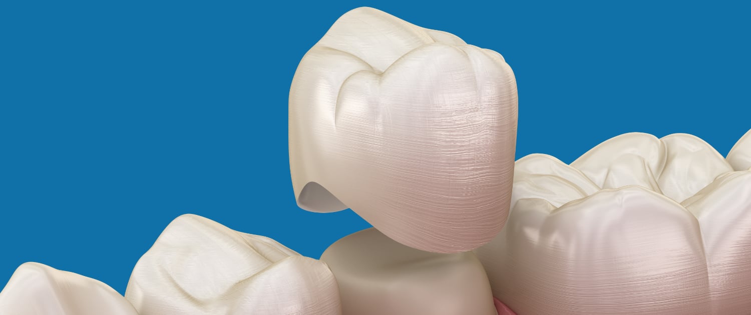 https://infinitysmiles.net/wp-content/uploads/2021/06/slider-dental-crowns.jpg